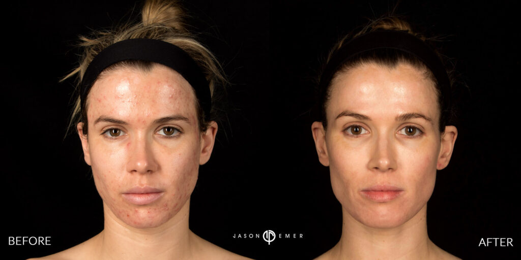 Acne Scar Facial Redness Female Before and After Los Angeles