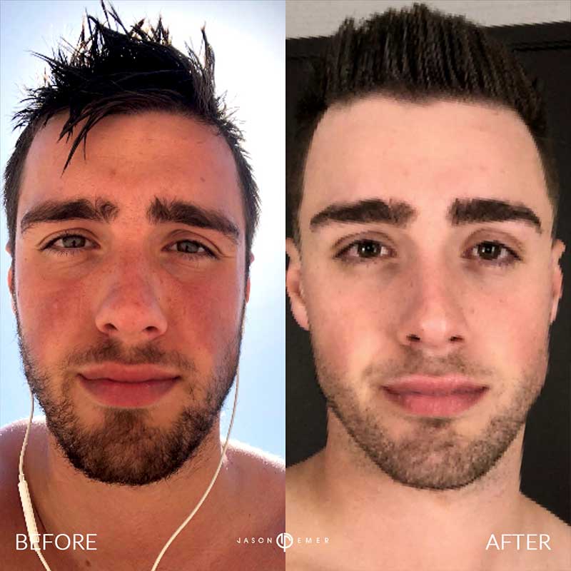 Aerify Complexion Kit | Before and After | Dr. Jason Emer MD | | Beverly Hills, CA