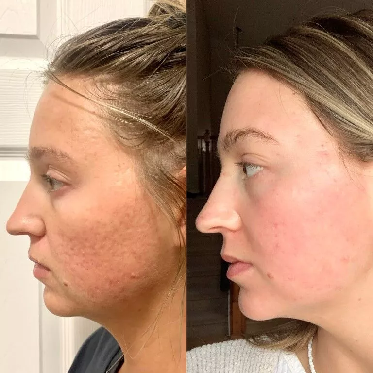 Acne-Treatment-2-Jason-Emer-2 (1)