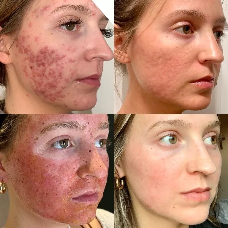 Acne-Treatment-3-Jason-Emer-3