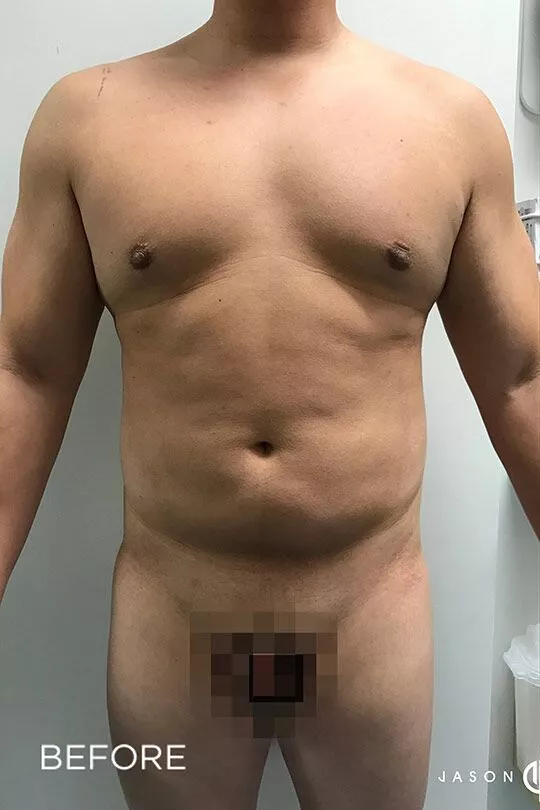 Male-Gladiator-Lipo-bxa_01