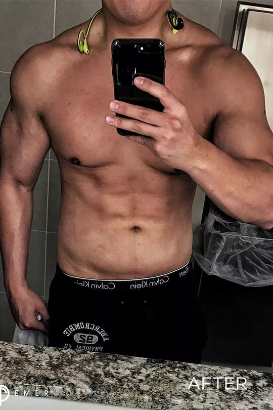 Male-Gladiator-Lipo-bxa_02
