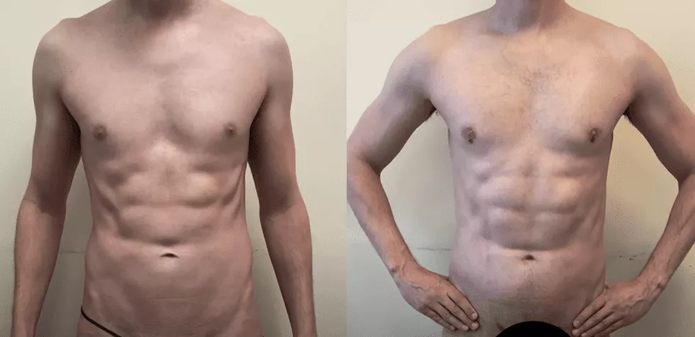 Abdominal Etching Result done by Dr. Jason Emer