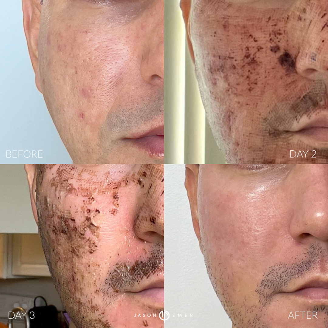 co2-laser-resurfacing-bxa-2-1080x1080