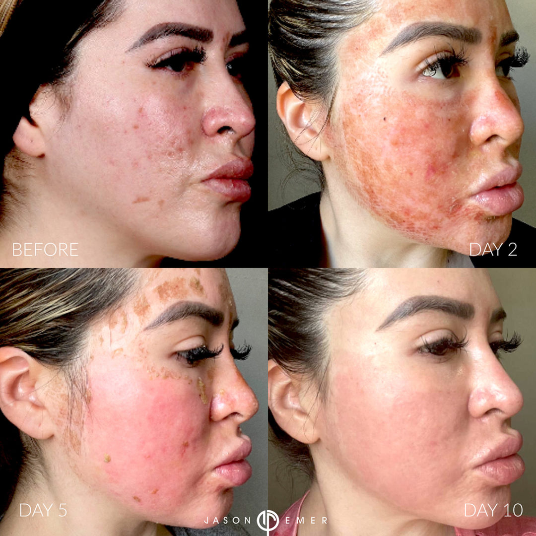 co2-resurfacing-and-chemical-peel-bxa2-1080x1080