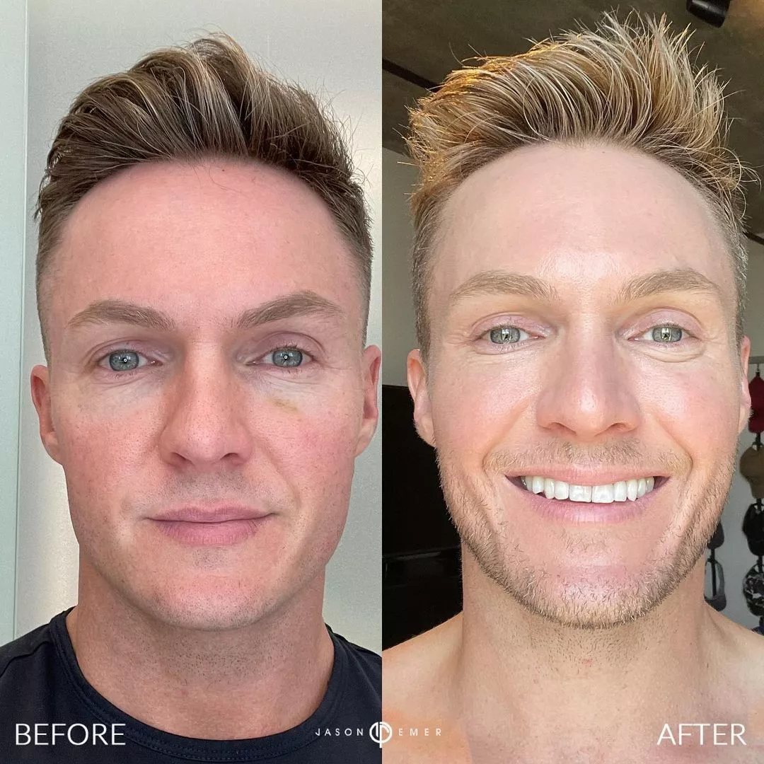 emerage-before and after 3 plasma pen