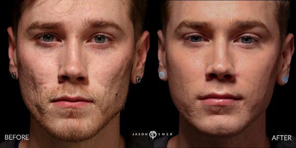 Chemical Peel | Before and After | Dr. Jason Emer MD | | Beverly Hills, CA
