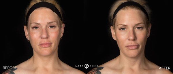 Dermaplaning | Before and After | Cosmetic Dermatologist | Dr. Jason Emer MD | Beverly Hills, CA